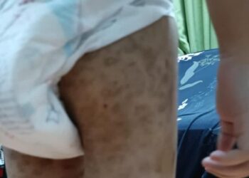 KEADAAN kanak-kanak berusia empat tahun menjadi mangsa dera bapa angkat di sebuah pangsapuri di Ampang Jaya.