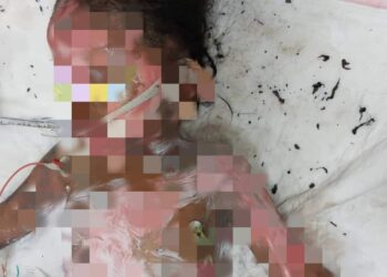 KANAK-KANAK perempuan melecur hampir 46 peratus anggota badannya dipercayai akibat disambar api di Pendang.