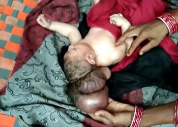 Keadaan bayi berkepala tiga yang dilahirkan di Uttar Pradesh. India. - Daily Star.