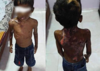 KEADAAN salah seorang anak M. Vikneswari yang disyaki didera pengasuh di Taman Selesa Jaya, Skudai di Johor.