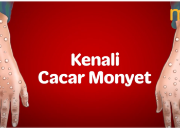 cacar monyet