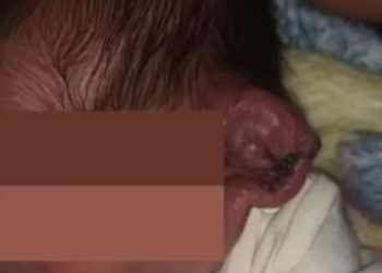 SEORANG bayi hampir kehilangan telinga kiri akibat kecuaian doktor semasa melakukan pembedahan di Mexico.-TIKTOK