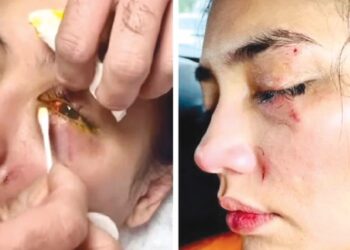 KEADAAN mata Fasha Sandha selepas terhentak di bucu katil semasa menjalani penggambaran drama Anak Tuan.