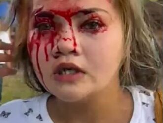 GAMBAR tular remaja perempuan yang luka di kening selepas diserang menggunakan kunci kereta dalam satu pergaduhan di Pantai Merdeka, Kuala Muda di Sungai Petani, hari ini.