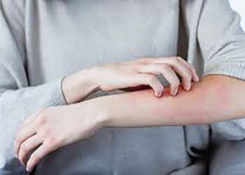 Atopic dermatitis (AD) sering disalaherti sebagai ekzema.