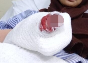 Nor Shuhadah Aznan terpaksa menahan kesakitan hampir 45 minit apabila dua jari kirinya tersepit pada mesin memerah santan semi auto di premisnya di Taman Perda, Teluk Kumbar, Pulau Pinang semalam.
