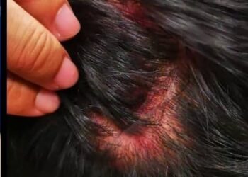 MANGSA menunjukkan luka akibat diserang dua suspek akibat tidak berpuas hati disaman kerana kenderaan menghalang lalu-lintas.