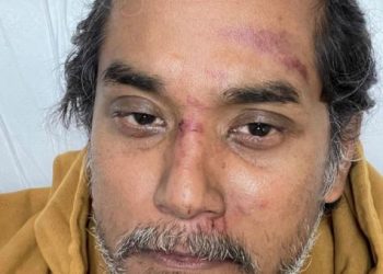 Keadaan Khairy Jamaluddin yang cedera di muka selepas terlibat dalam satu kemalangan semasa mengayuh basikal di Kampung Sri Chedding, Banting, baru-baru ini.