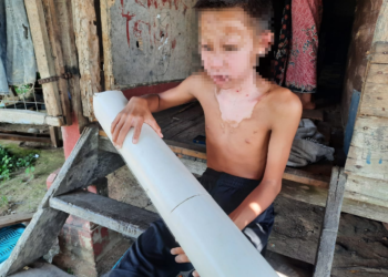 MANGSA yang cedera di muka dan dan dada akibat disambar api menunjukkan meriam batang paip buatan sendiri yang meletup di Kampung Ulu, Padang Sanai, Padang Terap. - UTUSAN/MOHD. RIFAAT ABD. HAMID