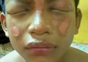 KEADAAN muka Muhammad Indera Syafiq Ariffin yang cedera disambar api ketika bermain mercun roket di Kampung Kuala Sungai Yan, Yan, Khamis lalu. - UTUSAN/OTHMAN YAHAYA