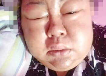 KEADAAN muka dan tangan Nor Azwa Azmi kian membengkak ekoran mengalami komplikasi buah pinggang dan dirawat di Hospital Seberang Jaya, Butterworth, Pulau Pinang.