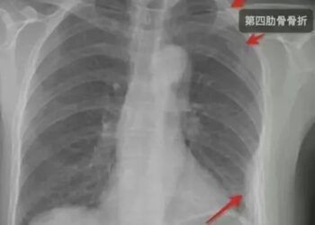 Ujian X-ray mendapati tulang rusuk wanita warganegara China patah akibat dipeluk dengan kuat.-AGENSI