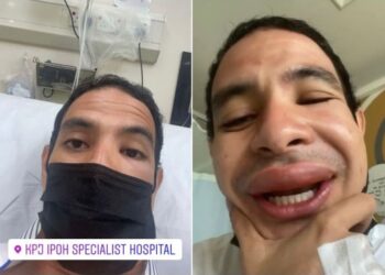 KEADAAN bibir Harris yang bengkak disengat tebuan kini semakin surut.