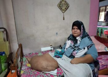 NORHAYATI ABU BAKAR menunjukkan penyakit kaki gajah yang dihidapi sejak lapan tahun lalu di rumahnya di Kampung Permatang Sepam, Benut, Pontian.